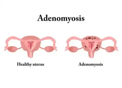 adenomyosis.jpg