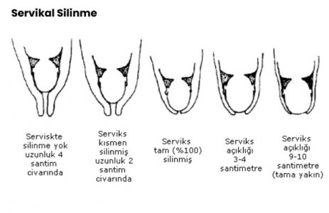 servikal_silinme_nedir.jpg