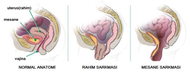 Histerektomi Sonrası Prolapsus Geliştirme Şansı.jpg