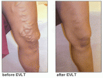 $before-after-veins-laser-treatment.gif