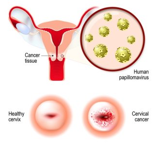 hpv_ve_pap_smear_testi.jpg