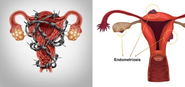 Endometriozis_nedir.jpg