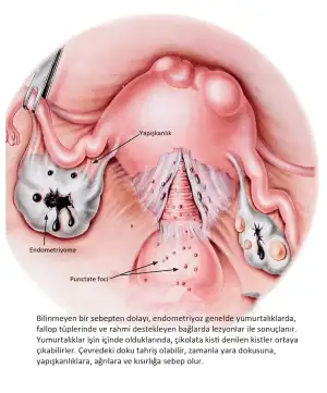 cikolata_kisti_kisirlik.webp