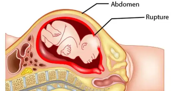 uterus_rupturu.webp