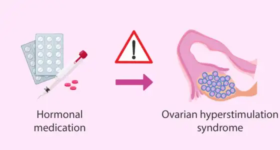 Ovaryan_Hiperstimulasyon_Sendromu.webp