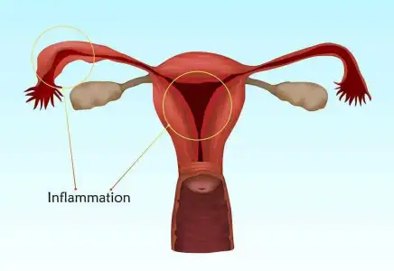 Pelvik İnflamatuar Hastalık Nedir, Belirtileri ve Tedavisi.webp