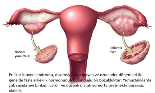 Polikistik over sendromu (PKOS).png