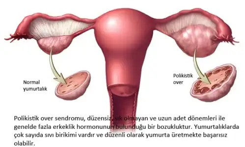 Polikistik over sendromu (PKOS).webp