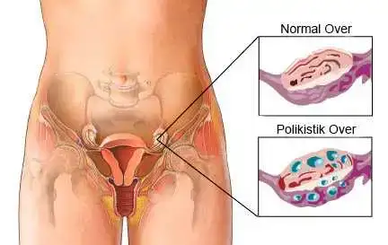 Polikistik Overde Tüp Bebek Tedavisi.webp