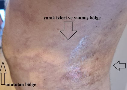 Yahya Baltu liposuction.jpg