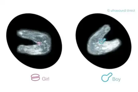 do-3-lines-on-an-ultrasound-mean-its-a-girl_147305-c0c0cde.webp