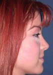 $rhinoplasty-4.jpg