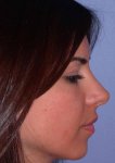 $rhinoplasty-14.jpg