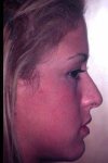 $rhinoplasty-3.jpg