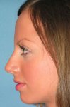 $rhinoplasty-78.jpg