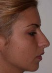 $rhinoplasty-13.jpg