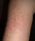 $keratosis pilaris.webp