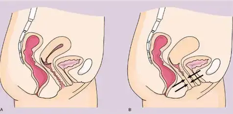 $vajinismus-vaginismus.webp