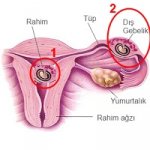 $heterotopik-gebelik.jpg