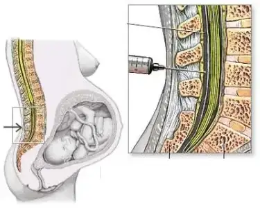 $epiduralspinal.webp