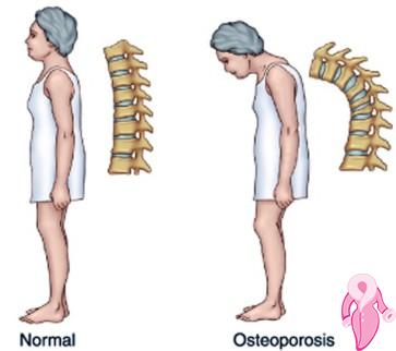 Osteoporoz Diyeti Nasıl Yapılır?