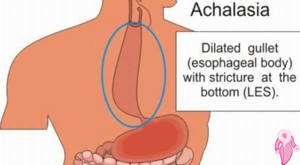 Akalazya Hastalığı Nedir? | 1