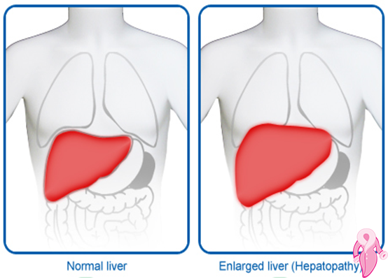 Grade 1 Hepatosteatoz Nedenleri, Belirtileri Ve Tedavi Yöntemleri | 1