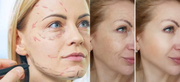 Facelift Nasıl Yapılır?