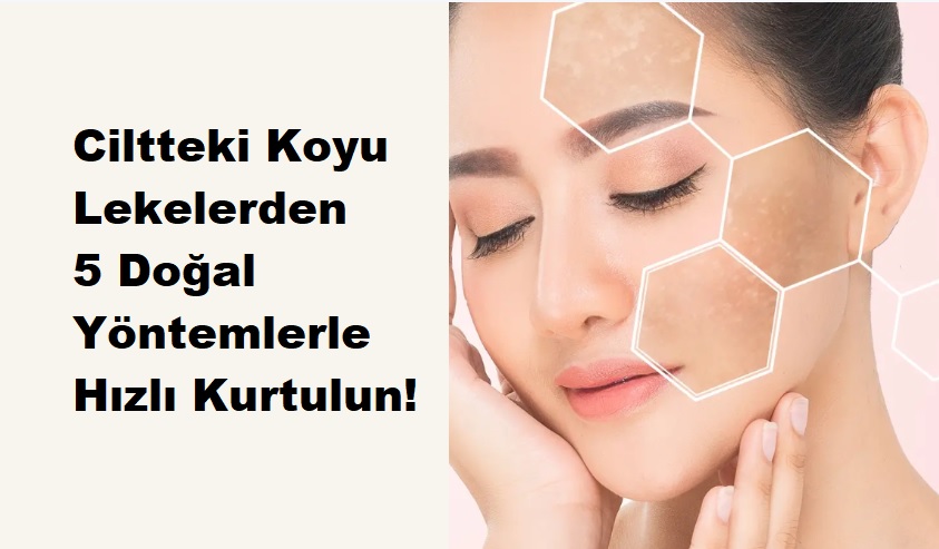 Ciltteki Koyu Lekelerden 5 Doğal Yöntemlerle Hızlı Kurtulun!