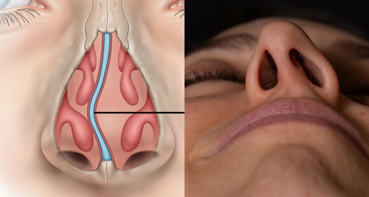 Septum Deviasyonu: Nefes Almayı Etkileyen Bir Sorun