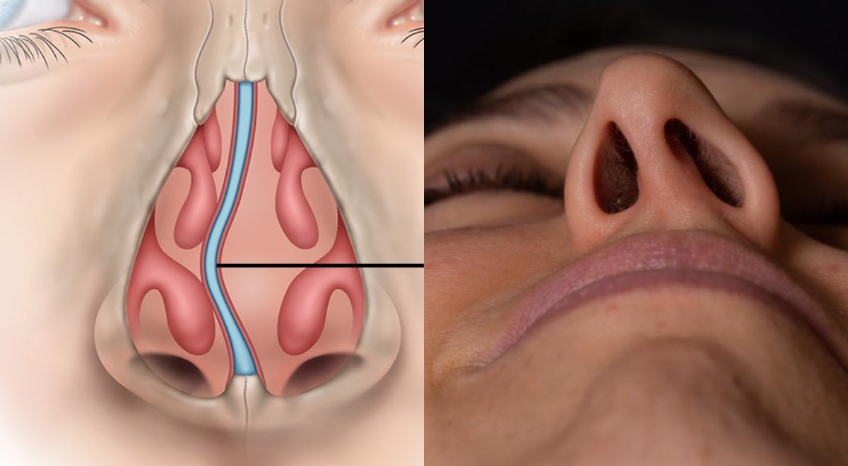 Septum Deviasyonu: Nefes Almayı Etkileyen Bir Sorun