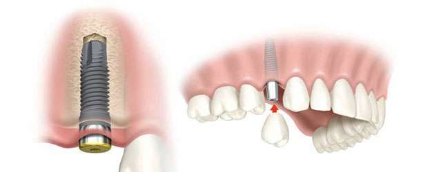 Dental İmplantlar Diş Ekimi